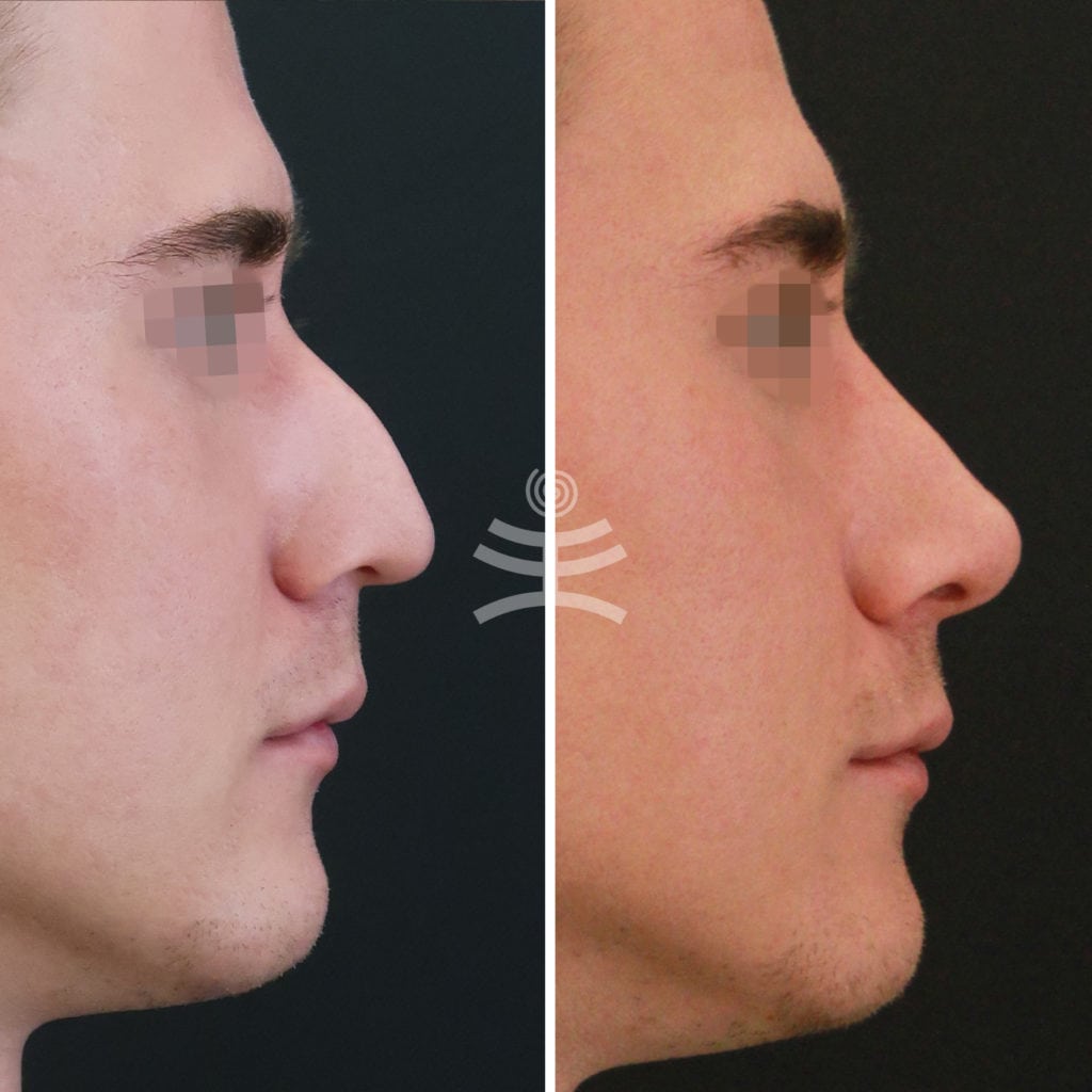 Операция носа горбинка носа