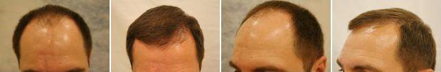 пересадка волос до и после