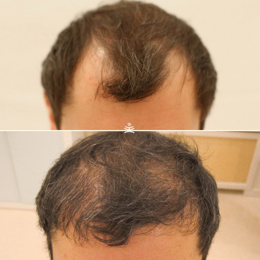 пересадка волос на брови фото