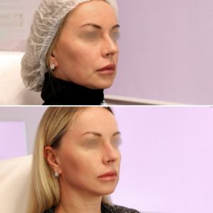 Мезотерапия липолитиками, ботулинотерапия, мезонити