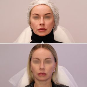 Мезотерапия липолитиками, ботулинотерапия, мезонити