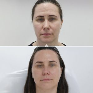 Пилинги, мезотерапия, диспорт