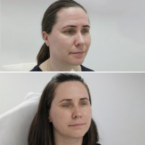 Пилинги, мезотерапия, диспорт
