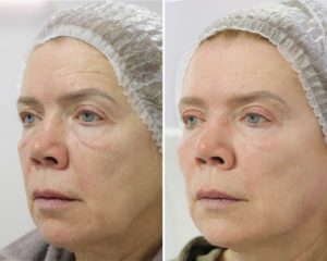 Фототерапия + Биоревитализация +Контурная пластика + Блефаропластика