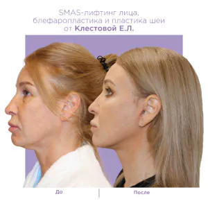 SMAS-лифтинг лица, платизмопластика и блефаропластика