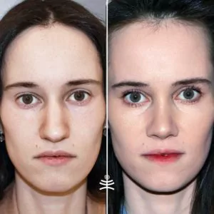 Ринопластика у Мрочко И.
