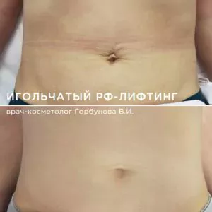 Игольчатый RF-лифтинг