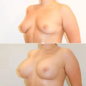 Увеличение груди имплантами Sebbin