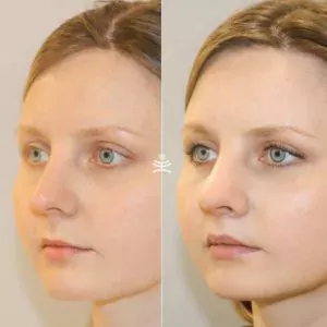 Хейлопластика и булхорн