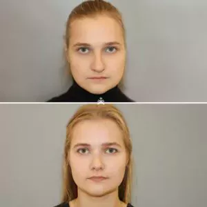 Риносептопластика